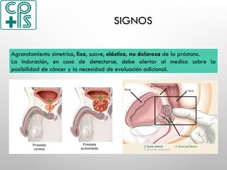 SIGNOS
Agrandamiento liso, suave y elástico de la próstata.
La induración, en caso de detectarse, debe alertar al medico sobre la
posibilidad de cáncer y la necesidad de evaluación adicional.
Agrandamiento simetrico, liso, suave, elástico, no dolorosa de la próstata.
La induración, en caso de detectarse, debe alertar al medico sobre la
posibilidad de cáncer y la necesidad de evaluación adicional.
 
