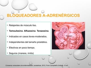 • Relajantes de músculo liso.
• Tamsulosina. Alfuzosina. Terazosina.
• Indicados en casos leves-moderados.
• Independientes del tamaño prostático.
• Efectivos en poco tiempo.
• Seguros (mareos, rinitis)
Consenso venezolano de enfermedades prostaticas, 2012, From Campbell’s Urology. 12 ed.
BLOQUEADORES A-ADRENÉRGICOS
 