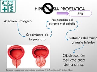 Crecimiento de
la próstata
Proliferación del
estroma y el epitelio
síntomas del tracto
urinario inferior
Obstrucción
del vaciado
de la orina.
Afección urológica
Consenso venezolano de enfermedades prostaticas, 2012, From Campbell’s Urology. 12 ed.
HIPERPLASIA PROSTATICA
SPB
 