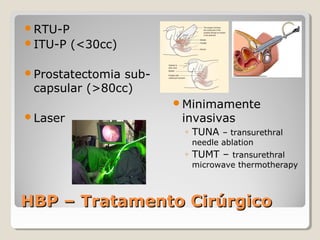 RTU-P
ITU-P

(<30cc)

Prostatectomia

subcapsular (>80cc)

Laser

Minimamente

invasivas

◦ TUNA – transurethral
needle ablation

◦ TUMT – transurethral

microwave thermotherapy

HBP – Tratamento Cirúrgico

 