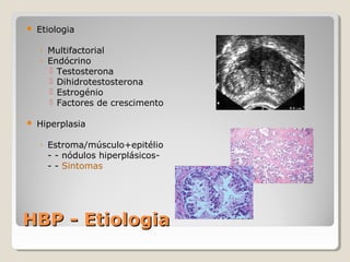 

Etiologia
◦ Multifactorial
◦ Endócrino
 Testosterona
 Dihidrotestosterona
 Estrogénio
 Factores de crescimento



Hiperplasia
◦ Estroma/músculo+epitélio
- - nódulos hiperplásicos- - Sintomas

HBP - Etiologia

 