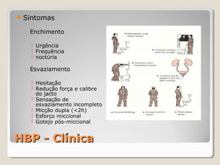  Sintomas

◦ Enchimento
 Urgência
 Frequência
 noctúria

◦ Esvaziamento
 Hesitação
 Redução força e calibre
do jacto
 Sensação de
esvaziamento incompleto
 Micção dupla (<2h)
 Esforço miccional
 Gotejo pós-miccional

HBP - Clínica

 