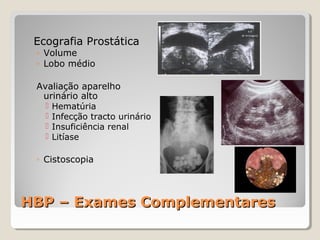 Ecografia Prostática
◦ Volume
◦ Lobo médio

Avaliação aparelho
urinário alto





Hematúria
Infecção tracto urinário
Insuficiência renal
Litíase

◦ Cistoscopia

HBP – Exames Complementares

 