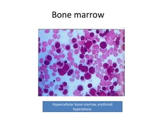 Hypercellular hemoglobinopathies | PPTX