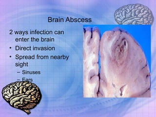 Brain Abscess 2 ways infection can enter the brain Direct invasion  Spread from nearby sight Sinuses Ears Teeth 