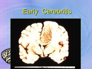 Early  Cerebritis 