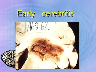 Early  cerebritis 