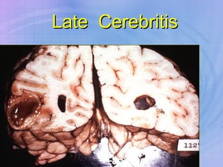 Late  Cerebritis 
