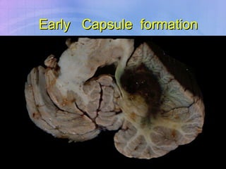 Early  Capsule  formation 