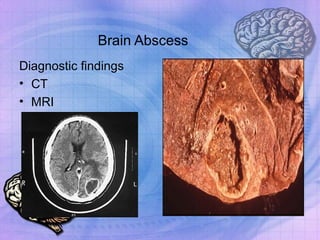 Brain Abscess Diagnostic findings CT MRI 
