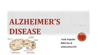 ALZHEIMERS
DISEASE
Yash Tripathi
BMLS Sec B
230612032159
 