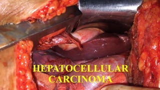 HEPATOCELLULAR
CARCINOMA
 