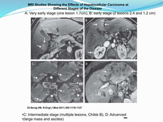 MRI Studies Showing the Effects of Hepatocellular Carcinoma at
Different Stages of the Disease.
El-Serag HB. N Engl J Med 2011;365:1118-1127
A: Very early stage (one lesion 1.7cm), B: early stage (2 lesions 2.4 and 1.2 cm)
•C: Intermediate stage (multiple lesions, Childs B), D: Advanced
•(large mass and ascites)
 