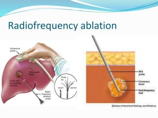 Radiofrequency ablation
 