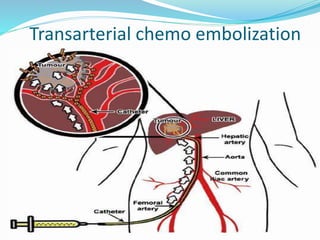 Transarterial chemo embolization
 