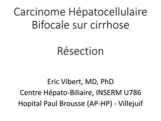 Carcinome Hépatocellulaire
Bifocale sur cirrhose
Résection
Eric Vibert, MD, PhD
Centre Hépato-Biliaire, INSERM U786
Hopital Paul Brousse (AP-HP) - Villejuif
 