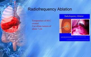 Radiofrequency Ablation
Temperature of 60 C
created
Can ablate tumors of
about 7 cm
 