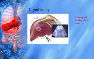 Cryotherapy
Freezing and
thawing of the
tumor
 