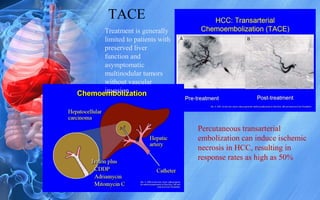 TACE
Percutaneous transarterial
embolization can induce ischemic
necrosis in HCC, resulting in
response rates as high as 50%
Treatment is generally
limited to patients with
preserved liver
function and
asymptomatic
multinodular tumors
without vascular
invasion
 