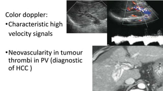Hcc(hepatocellular carcinoma) | PPTX