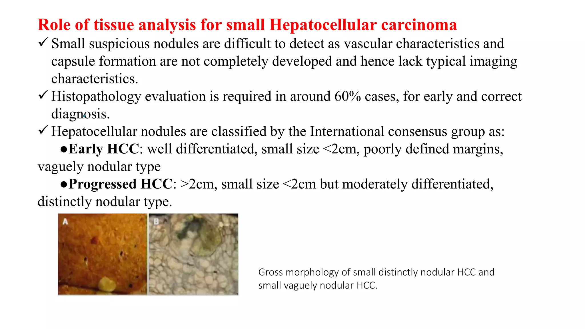 Hepatocellular carcinoma | PPTX