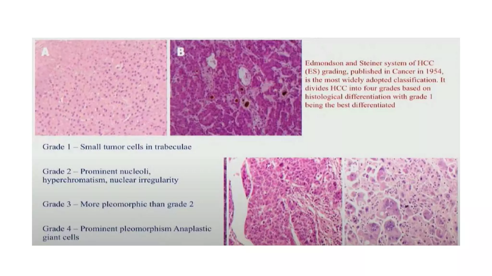 Hepatocellular carcinoma | PPTX