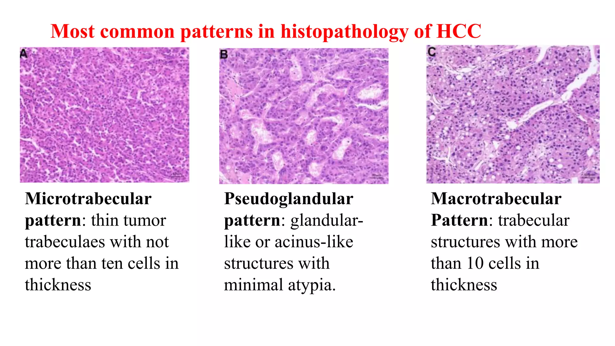 Hepatocellular carcinoma | PPTX | Cancer | Diseases and Conditions