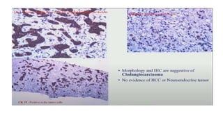 Hepatocellular carcinoma | PPTX