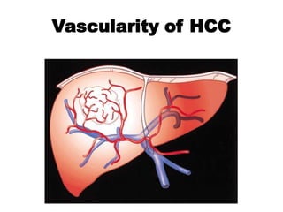Vascularity of HCC
 