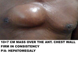 10×7 CM MASS OVER THE ANT. CHEST WALL
FIRM IN CONSISTENCY
P/A- HEPATOMEGALY
 