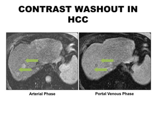 CONTRAST WASHOUT IN
       HCC




 Arterial Phase   Portal Venous Phase
 