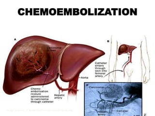 CHEMOEMBOLIZATION




Image courtesy of www.hopkinscoloncancercenter.org.
 