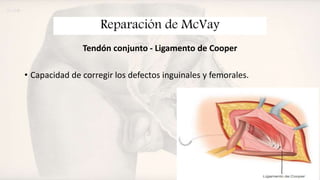 Mcvay Incision Hernia inguinal | PPTX