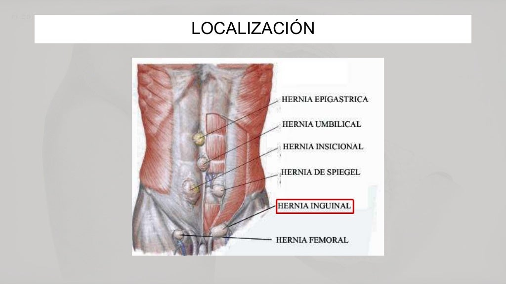 Hernia inguinal