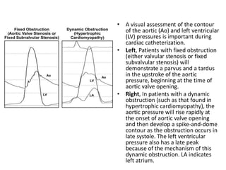 • A visual assessment of the contour
of the aortic (Ao) and left ventricular
(LV) pressures is important during
cardiac catheterization.
• Left, Patients with fixed obstruction
(either valvular stenosis or fixed
subvalvular stenosis) will
demonstrate a parvus and a tardus
in the upstroke of the aortic
pressure, beginning at the time of
aortic valve opening.
• Right, In patients with a dynamic
obstruction (such as that found in
hypertrophic cardiomyopathy), the
aortic pressure will rise rapidly at
the onset of aortic valve opening
and then develop a spike-and-dome
contour as the obstruction occurs in
late systole. The left ventricular
pressure also has a late peak
because of the mechanism of this
dynamic obstruction. LA indicates
left atrium.
 