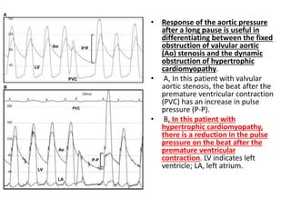 • Response of the aortic pressure
after a long pause is useful in
differentiating between the fixed
obstruction of valvular aortic
(Ao) stenosis and the dynamic
obstruction of hypertrophic
cardiomyopathy.
• A, In this patient with valvular
aortic stenosis, the beat after the
premature ventricular contraction
(PVC) has an increase in pulse
pressure (P-P).
• B, In this patient with
hypertrophic cardiomyopathy,
there is a reduction in the pulse
pressure on the beat after the
premature ventricular
contraction. LV indicates left
ventricle; LA, left atrium.
 