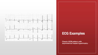 Hcm Examples HCM Hypertrophic cardiomyopathy.pptx