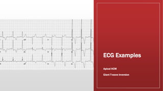HCM Hypertrophic cardiomyopathy.pptx