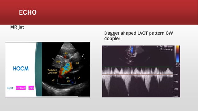 HCM Hypertrophic cardiomyopathy.pptx