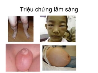Triệu chứng lâm sàng
 