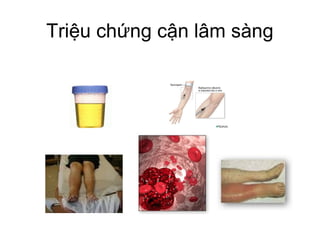 Triệu chứng cận lâm sàng
 