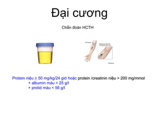 Đại cương
Chẩn đoán HCTH
Protein niệu > 50 mg/kg/24 giờ hoặc protein /creatinin niệu > 200 mg/mmolprotein /creatinin niệu > 200 mg/mmol
+ albumin máu < 25 g/l
+ protid máu < 56 g/l
 