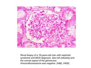 Renal biopsy of a 16-years-old man with nephrotic
syndrome and MCD diagnosis. See tuft cellularity and
the normal aspect of the glomerulus.
Immunofluorescence was negative. (H&E, X400).
 