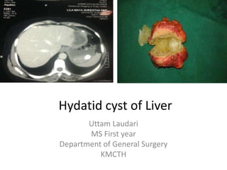 Hydatid cyst of Liver
Uttam Laudari
MS First year
Department of General Surgery
KMCTH
 