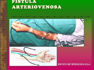 FÍSTULA  ARTERIOVENOSA   