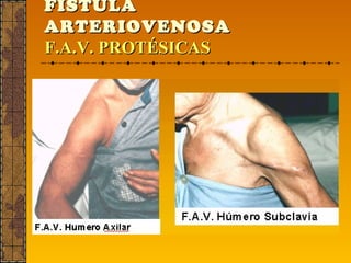 FÍSTULA  ARTERIOVENOSA   F.A.V. PROTÉSICAS   