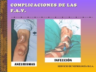 COMPLICACIONES DE LAS F.A.V.   SERVICIO DE NEFROLOGÍA H.G.A. ANEURISMAS INFECCIÓN 