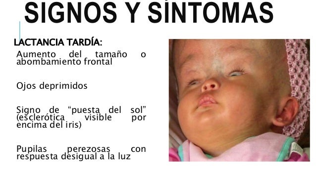 Ojos En Puesta De Sol Hidrocefalia