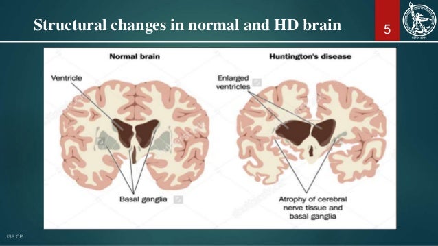 Huntington's disease & its Treatment