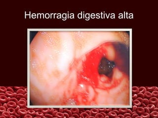 Hemorragia digestiva alta

 